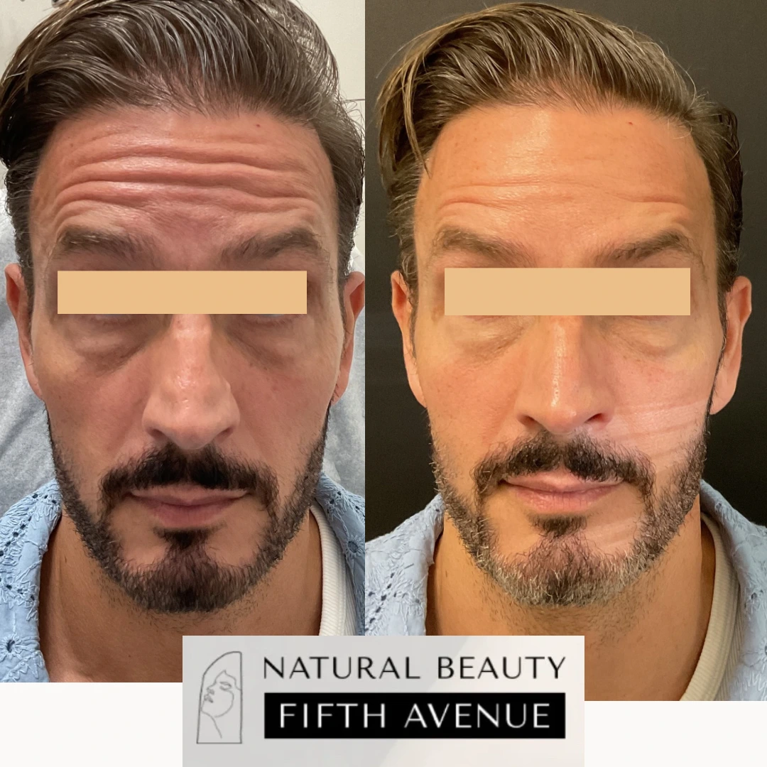 Before and after Botox injections in Chelsea showing reduced forehead wrinkles